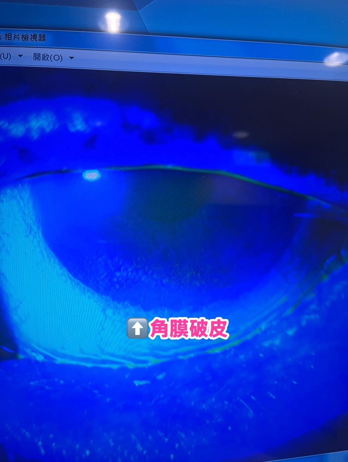 眼瞼內翻案例3