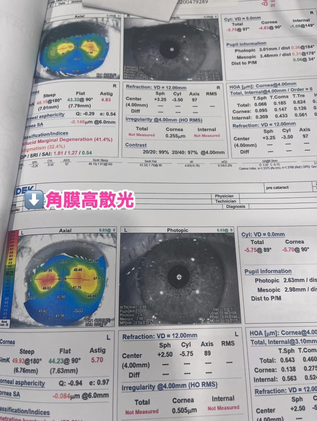 白內障健保片案例照 3
